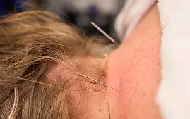 Dry Needling