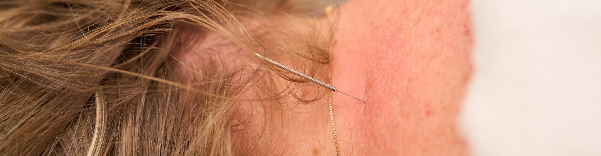 Dry Needling