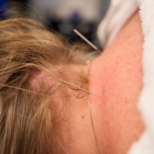 dry-needling-Thrive-Physical-Therapy-Olathe-KS