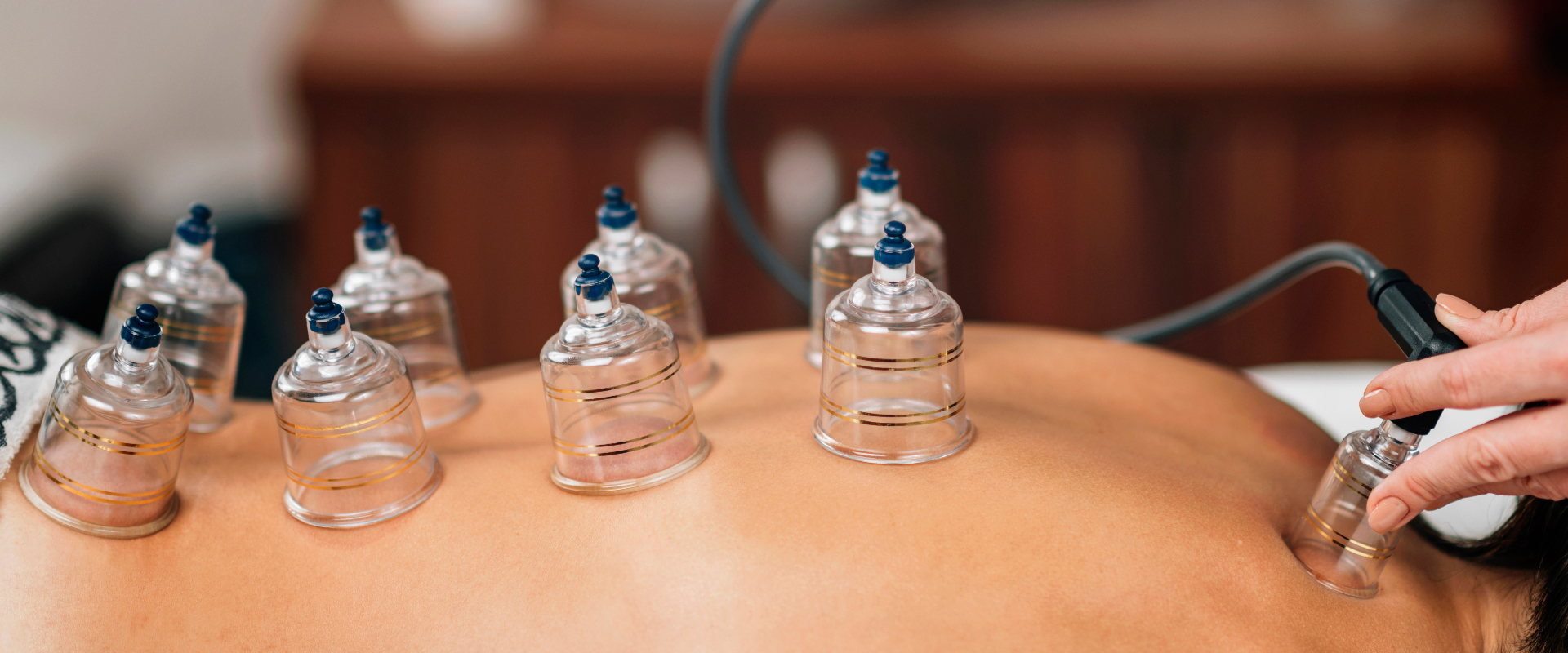 cupping-thrive-physical-therapy-olathe-ks